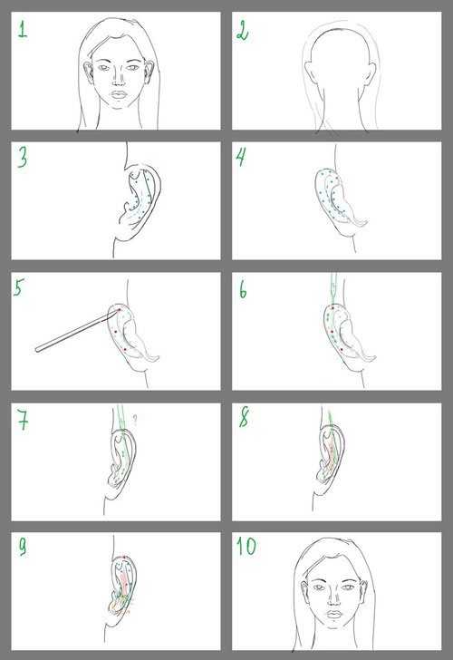 Отопластика